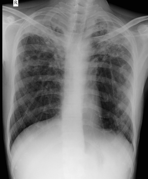 File:Chronic tuberculosis (Radiopaedia 28211).PNG