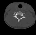 Clay-shoveler fracture (Radiopaedia 22568-22590 Axial bone window 52).jpg