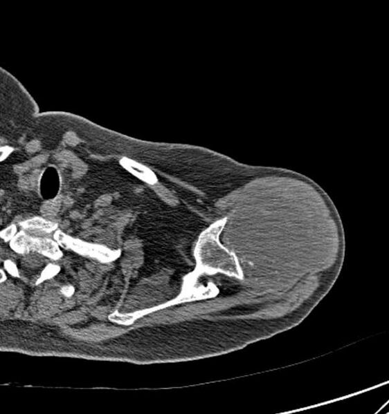 File:Clear cell chondrosarcoma - humerus (Radiopaedia 63104-71612 Axial non-contrast 25).jpg