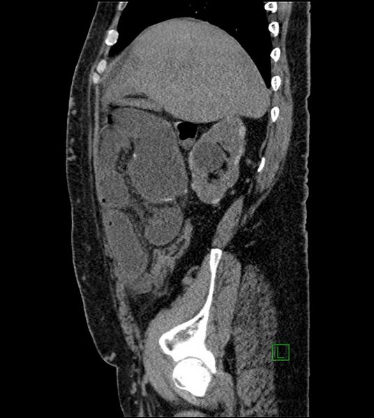 File:Closed-loop small bowel obstruction-internal hernia (Radiopaedia 78439-91096 C 107).jpg