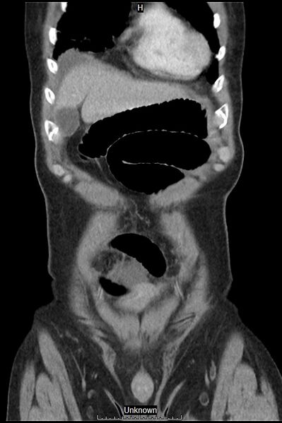 File:Closed loop bowel obstruction and ischemia (Radiopaedia 86959-103180 B 4).jpg
