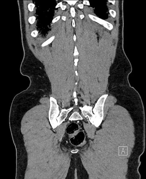 File:Closed loop small bowel obstruction - internal hernia (Radiopaedia 57806-64778 A 106).jpg