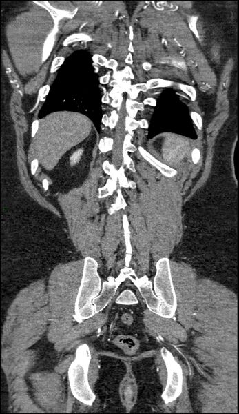 File:Coarctation of the aorta (Radiopaedia 74632-88521 B 210).jpg