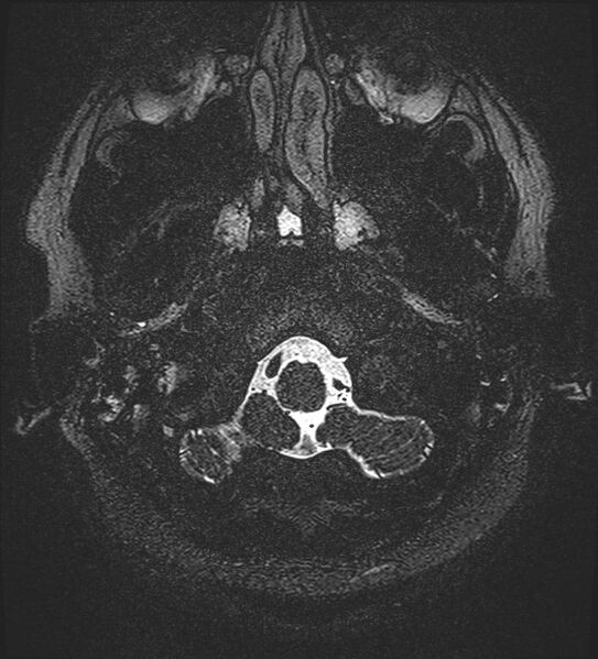 File:Cochlear incomplete partition type III associated with hypothalamic hamartoma (Radiopaedia 88756-105498 Axial T2 13).jpg