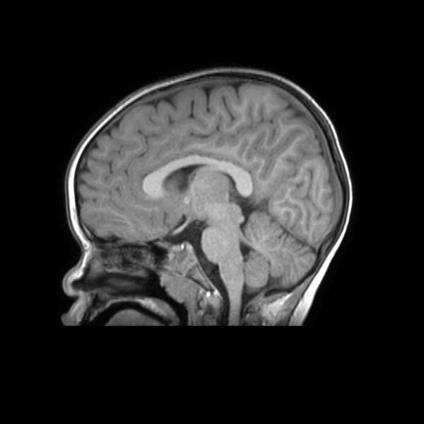 File:Cochlear nerve aplasia - unilateral (Radiopaedia 87910-104413 Sagittal T1 26).jpg
