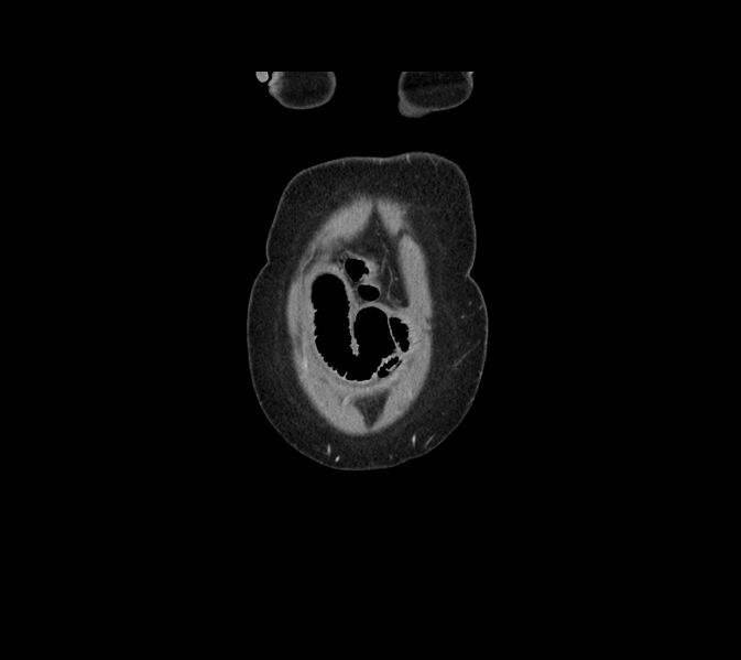 File:Cocoon abdomen with possible tubo-ovarian abscess (Radiopaedia 46235-50636 B 1).jpg