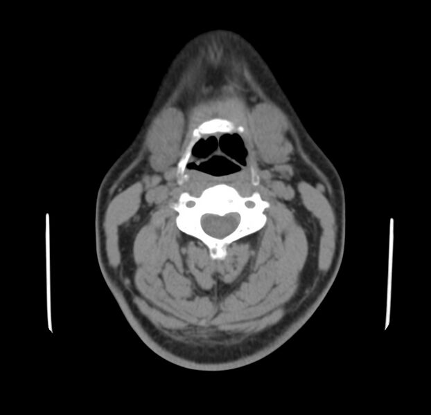 File:Colloid cyst of thyroid (Radiopaedia 22897-22923 Axial non-contrast 24).jpg