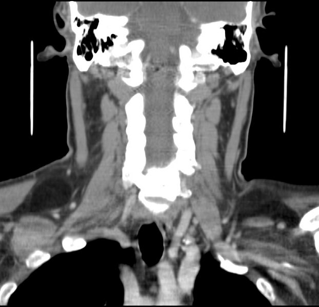 File:Colloid cyst of thyroid (Radiopaedia 22897-22923 Coronal C+ delayed 37).jpg
