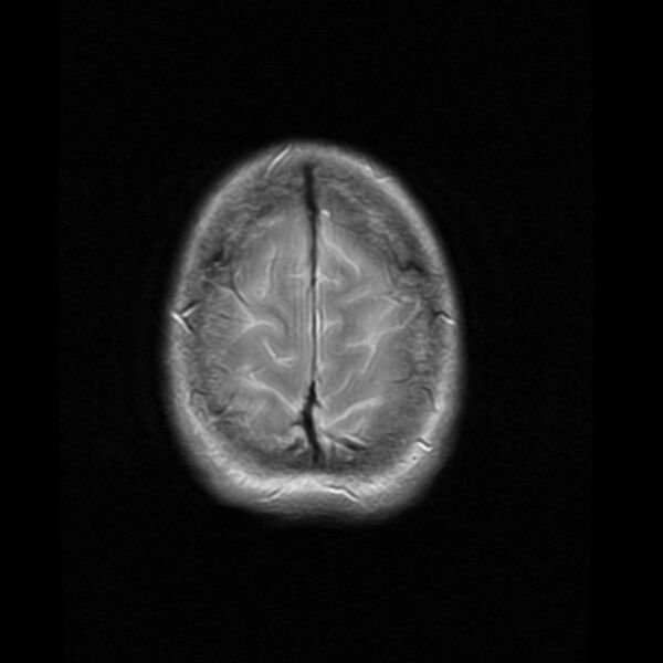 File:Colloid cyst with hydrocephalus (Radiopaedia 9373-10065 Axial PD 18).jpg