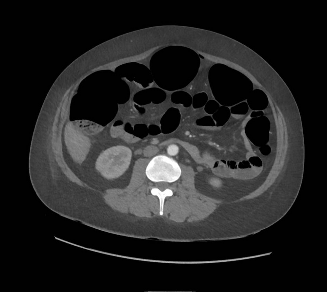 File:Colonic pseudo-obstruction (Radiopaedia 79752-92980 A 94).png