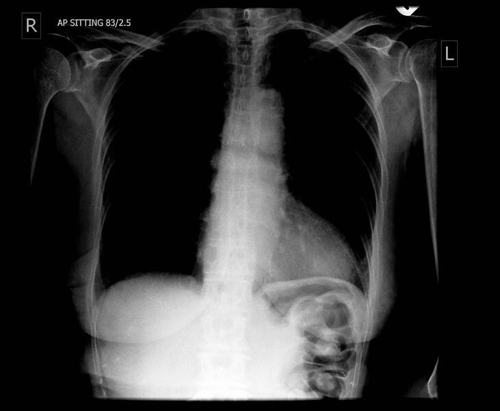 File:Esophageal stent (Radiopaedia 8815).jpg