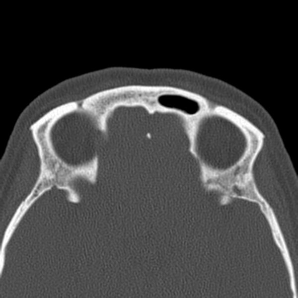 File:Nasolabial cyst (Radiopaedia 33987-35205 Axial bone window 40).jpg