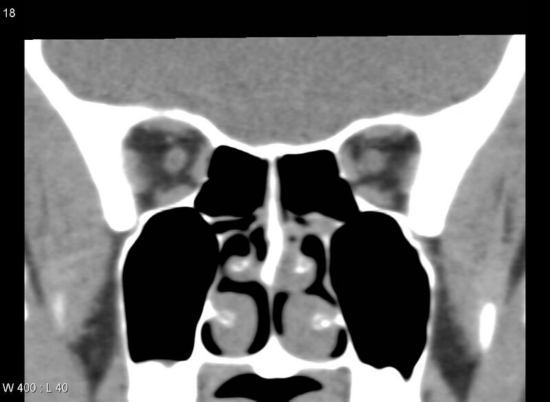 File:Nasolacrimal dacrocystocele (Radiopaedia 13814-13694 Coronal liver window 15).jpg