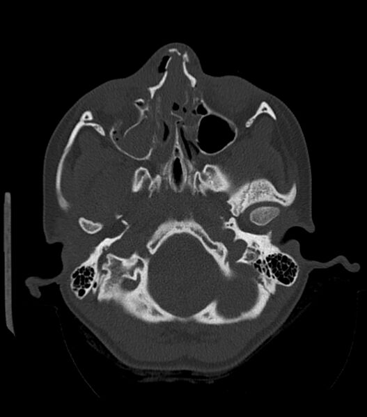 File:Nasoorbitoethmoid fracture (Radiopaedia 90044-107205 Axial 9).jpg