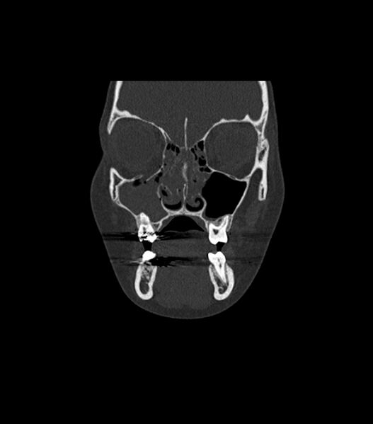 File:Nasoorbitoethmoid fracture (Radiopaedia 90044-107205 Coronal bone window 45).jpg
