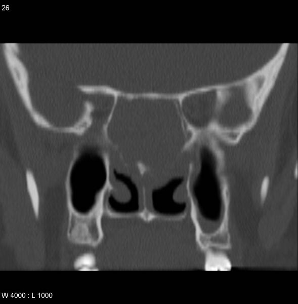File:Nasopharyngeal carcinoma (recurrent) (Radiopaedia 5061-6903 Coronal bone window 6).jpg