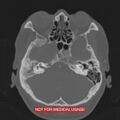 Nasopharyngeal carcinoma recurrence - skull base destruction (Radiopaedia 29107-29490 Axial bone window 82).jpg