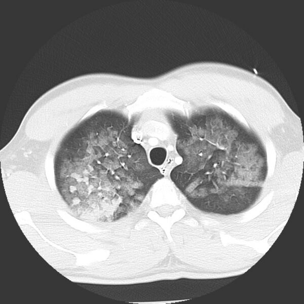 File:Near drowning pulmonary edema (Radiopaedia 16868-16591 Axial lung window 6).jpg