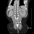 Neonatal neuroblastoma (Radiopaedia 56651-63438 Coronal non-contrast 41).jpg