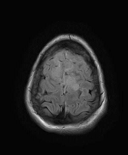 File:Neurofibromatosis type 2 (Radiopaedia 66211-75401 Axial FLAIR 25).jpg
