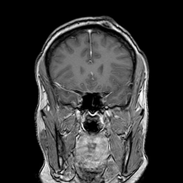 File:Neurofibromatosis type 2 (Radiopaedia 67470-76871 Coronal T1 C+ 9).jpg