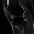 Non-displaced patella fracture (Radiopaedia 15932-15582 Sagittal T2 fat sat 14).jpg