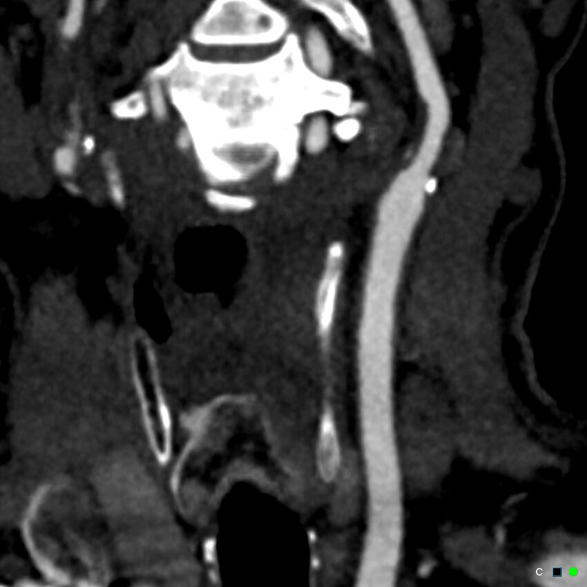 Non-occlusive intraluminal internal carotid artery thrombus (Radiopaedia 37751-39658 C 71).jpg