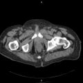 Non Hodgkin lymphoma in a patient with ankylosing spondylitis (Radiopaedia 84323-99624 Axial non-contrast 67).jpg
