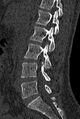 Normal CT lumbar spine (Radiopaedia 53981-60118 Sagittal bone window 41).jpg