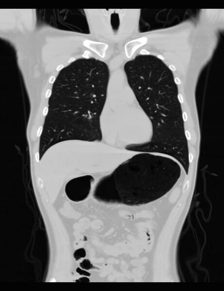 File:Normal CT virtual gastroscopy (Radiopaedia 29960-30501 F 13).jpg