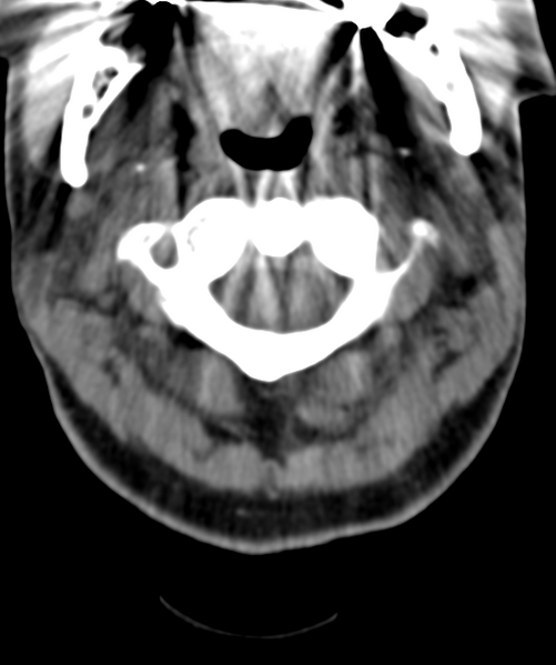File:Normal cervical spine MRI (including Dixon) (Radiopaedia 42762-45926 Axial non-contrast 13).png