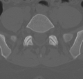 Normal lumbar spine CT (Radiopaedia 46533-50986 Axial bone window 62).png