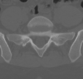 Normal lumbar spine CT (Radiopaedia 46533-50986 Axial bone window 65).png