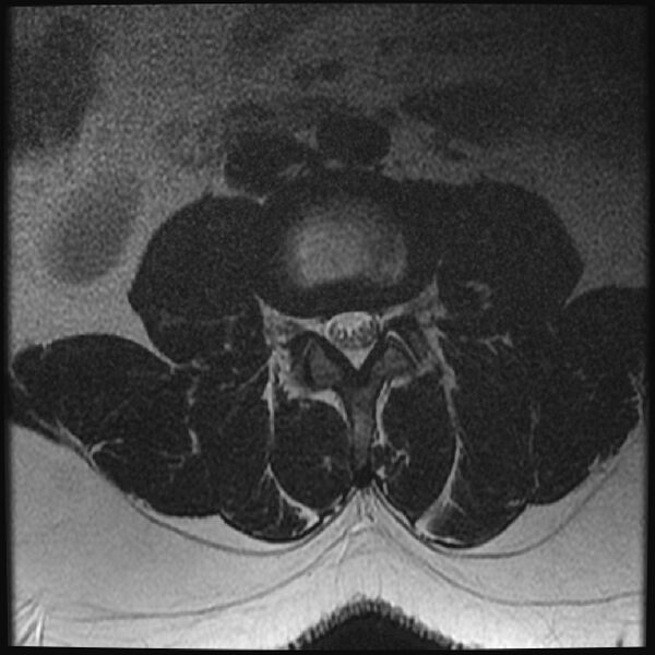 File:Normal lumbar spine MRI (Radiopaedia 43051-46311 Axial T2 13).jpg