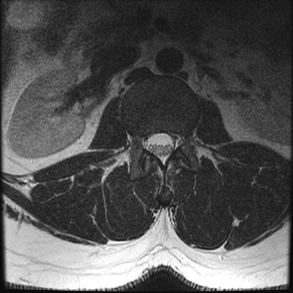 File:Normal lumbar spine MRI (Radiopaedia 43051-46311 Axial T2 5).jpg