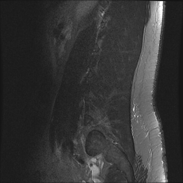 File:Normal lumbar spine MRI (Radiopaedia 43051-46311 Sagittal STIR 3).jpg