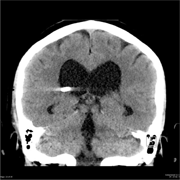 File:Normal pressure hydrocephalus (Radiopaedia 24415-24736 Coronal non-contrast 19).jpg