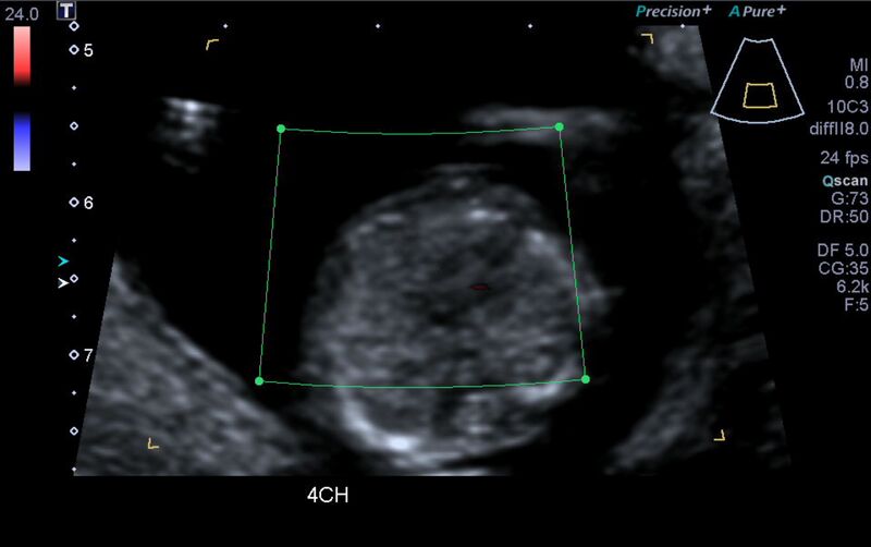 File:1st trimester nuchal-morphology ultrasound (Radiopaedia 44706-48477 Heart views cine with colour 54).jpg