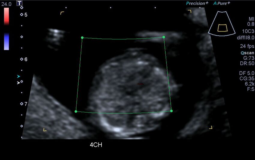 1st trimester nuchal-morphology ultrasound (Radiopaedia 44706-48477 Heart views cine with colour 54).jpg
