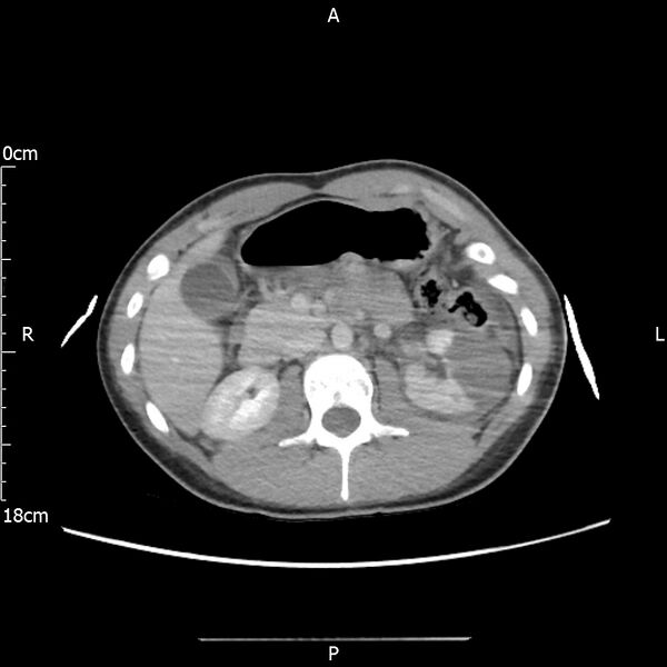 File:AAST grade IV kidney injury with CEUS follow-up (Radiopaedia 72353-82877 Axial C+ portal venous phase 27).jpg