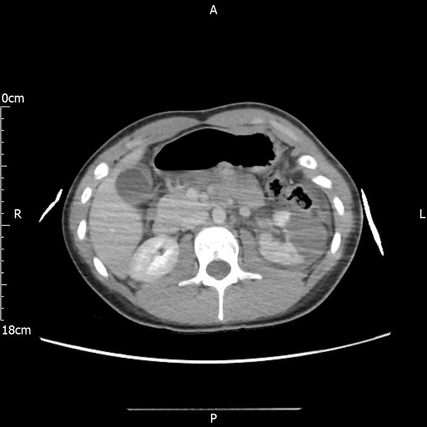 AAST grade IV kidney injury with CEUS follow-up (Radiopaedia 72353-82877 Axial C+ portal venous phase 27).jpg