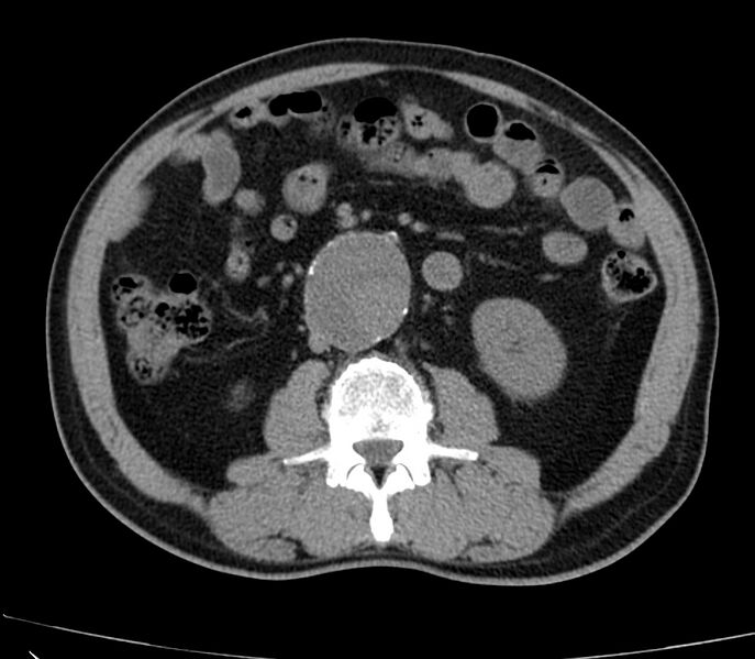 File:Abdominal aortic aneurysm (Radiopaedia 22421-22458 non-contrast 27).jpg