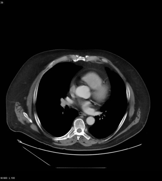 File:Abdominal aortic aneurysm with intramural hematoma then rupture (Radiopaedia 50278-55631 Axial C+ arterial phase 30).jpg
