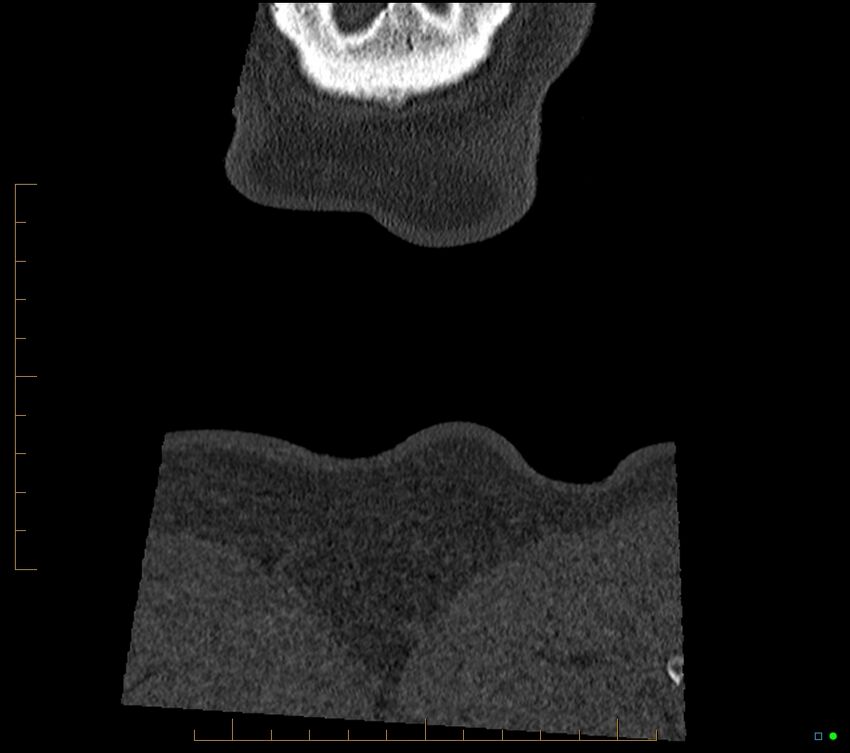 Accessory articulation of cervical transverse processes (Radiopaedia 82715-96933 Coronal non-contrast 142).jpg