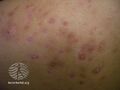 Acne affecting the back images (DermNet NZ acne-acne-back-154).jpg