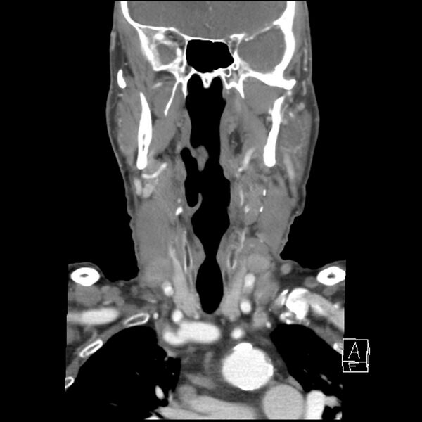 File:Acute ICA ischemic penumbra due to high-grade CCA stenosis (CT perfusion) (Radiopaedia 72038-82530 Coronal C+ arterial phase 14).jpg