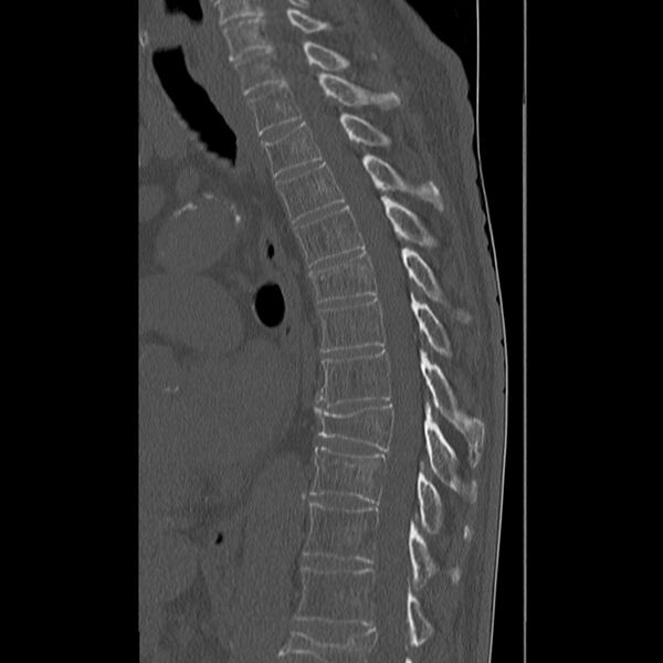 File:Acute and chronic vertebral compression fractures (Radiopaedia 31608-32494 Sagittal bone window 15).jpg