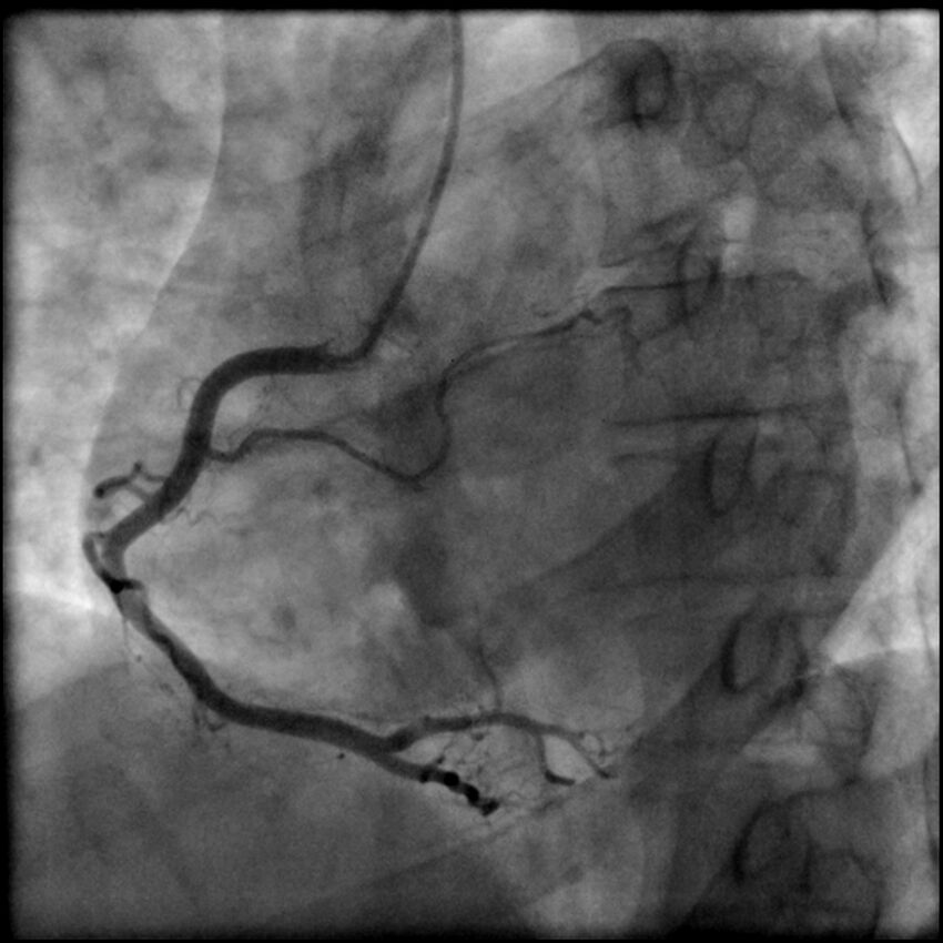 Acute anteroseptal myocardial infarction (Radiopaedia 68409-77946 RAO straight RCA 27).jpg