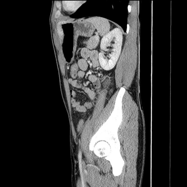 File:Acute appendicitis (Radiopaedia 27049-27227 Sagittal C+ portal venous phase 59).jpg