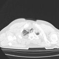 Acute aspiration pneumonitis (Radiopaedia 33605-34703 Axial lung window 15).jpg